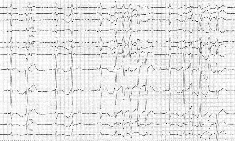 trace-8-15-ecg