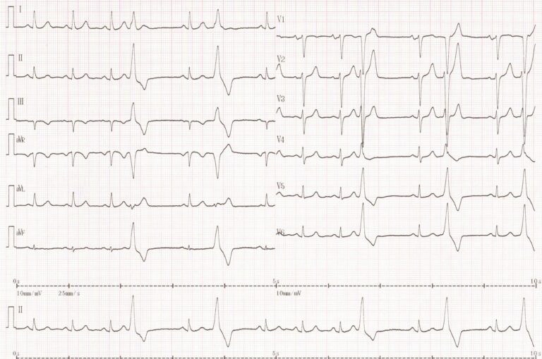 trace-8-2-ecg