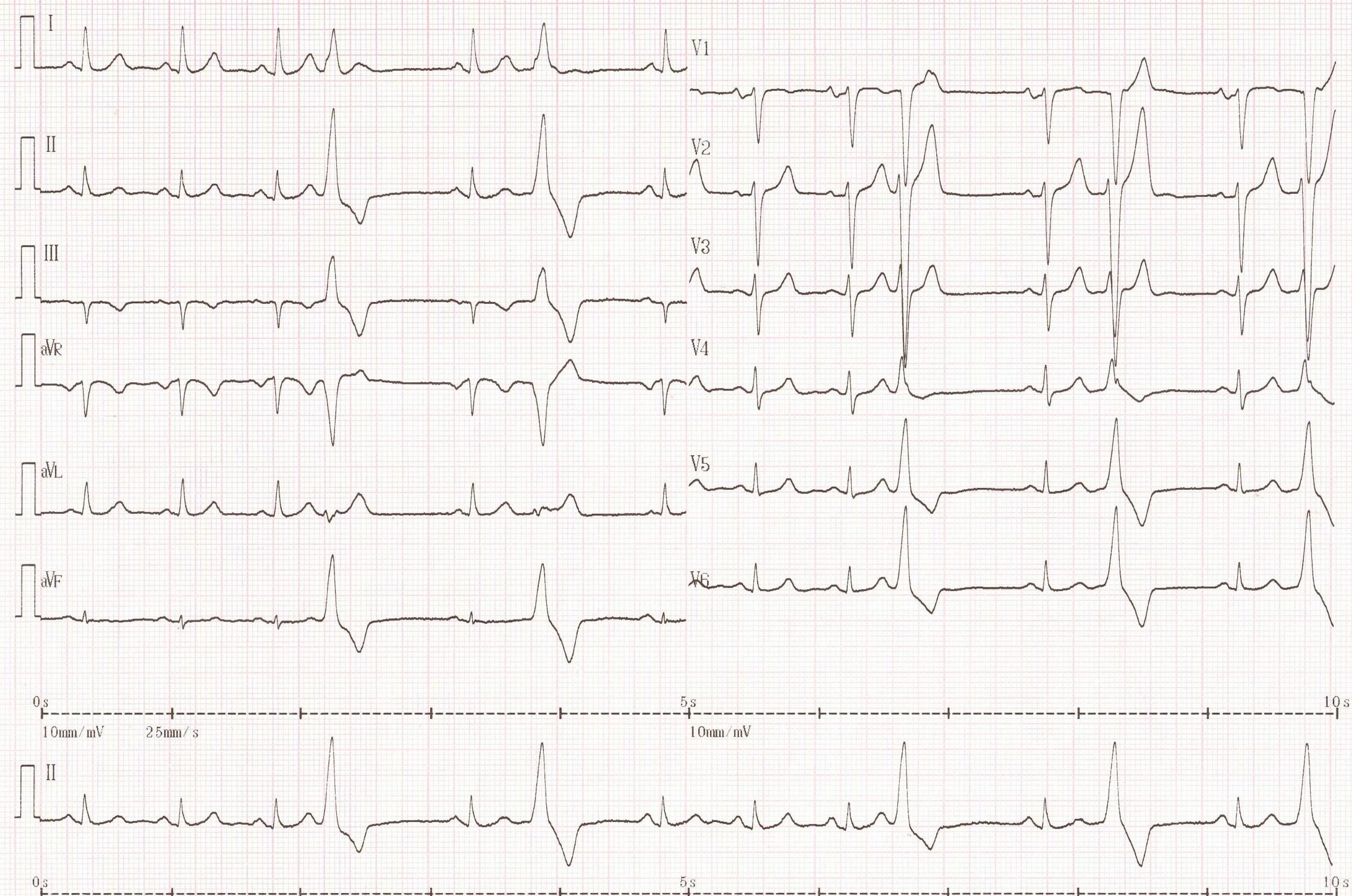trace-8-2-ecg