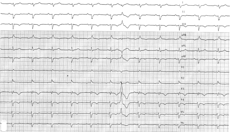 trace-8-3-ecg