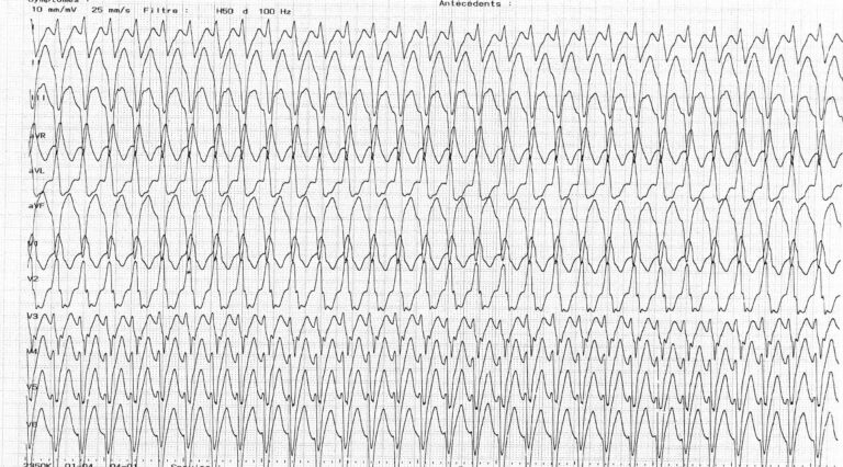 trace-8-4-ecg