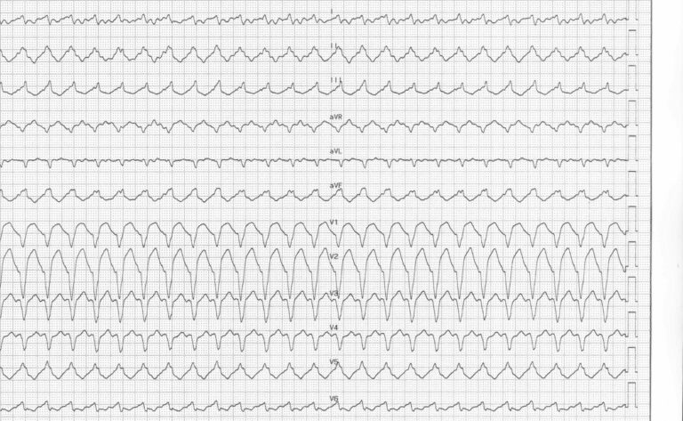 trace-8-5-ecg