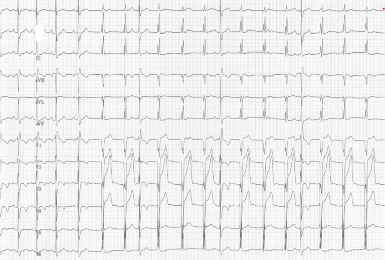 trace-8-6-ecg