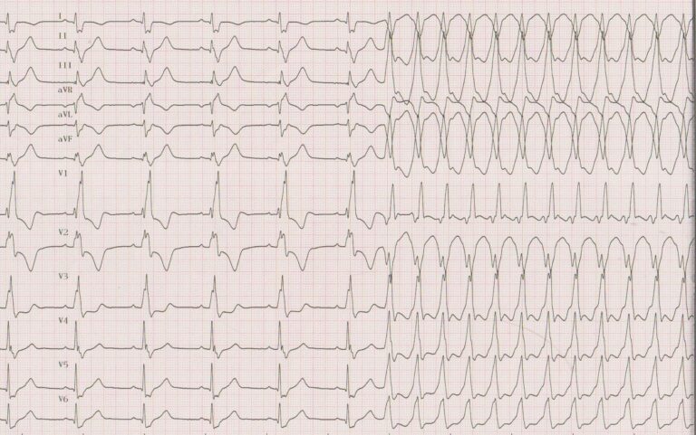 trace-8-7-ecg