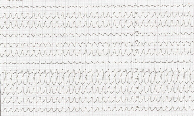 trace-8-8-ecg