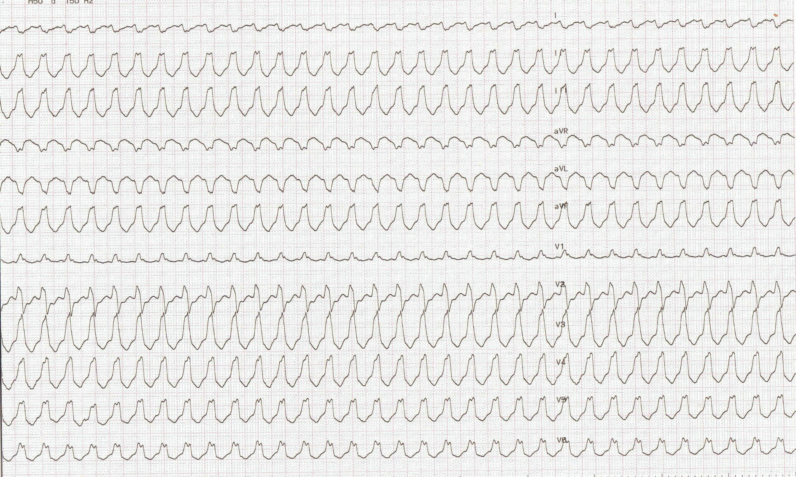 trace-8-8-ecg