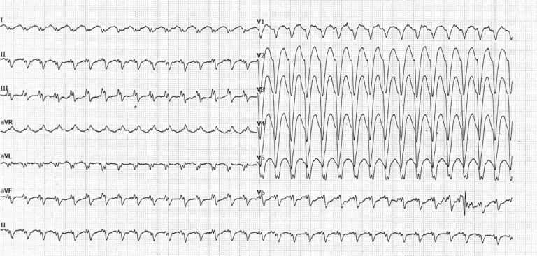 trace-8-9-ecg