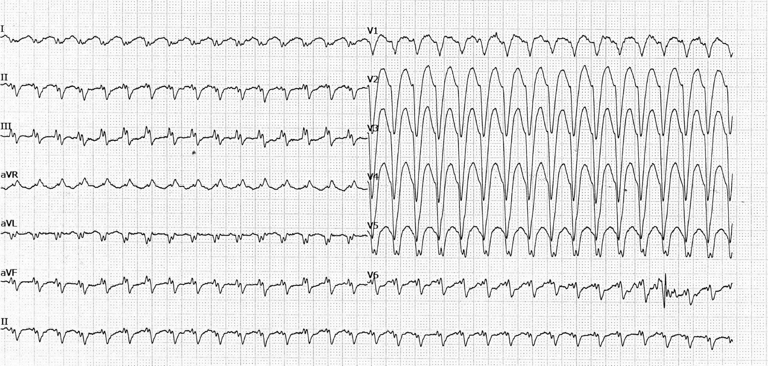 trace-8-9-ecg