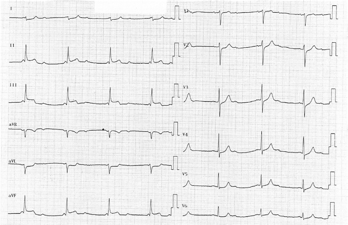 trace-1-12-ecg2