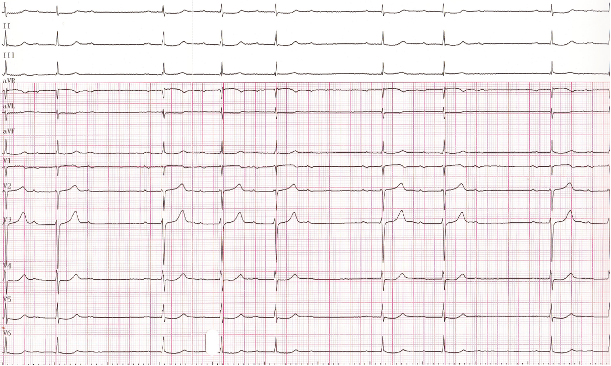 trace-1-5-ecg2