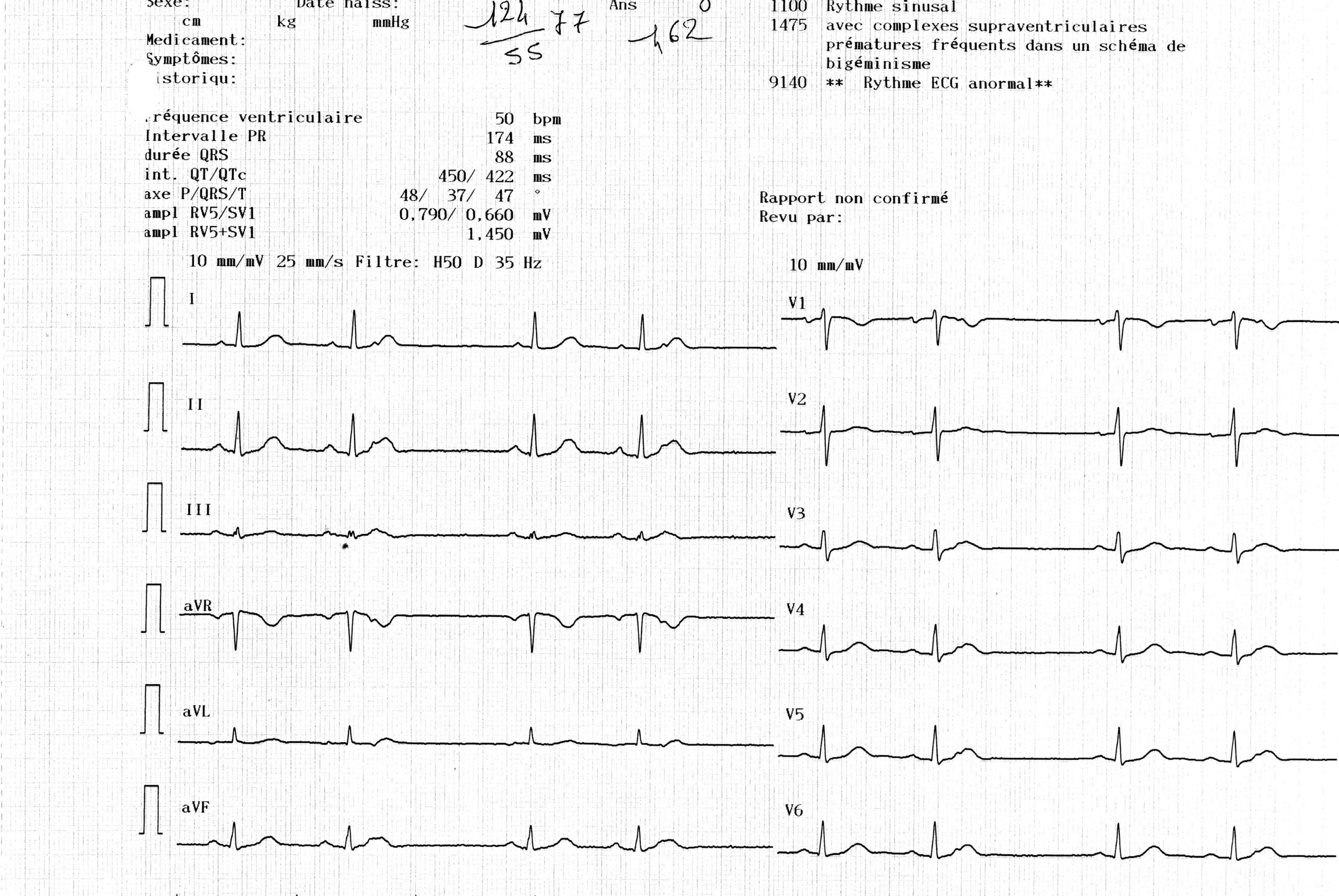trace-2-6-ecg