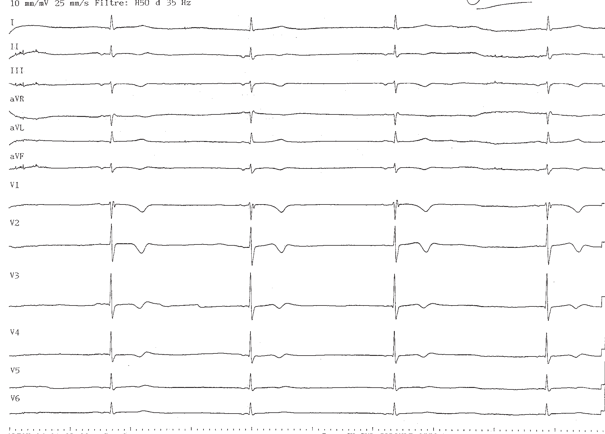trace-2-7-ecg2