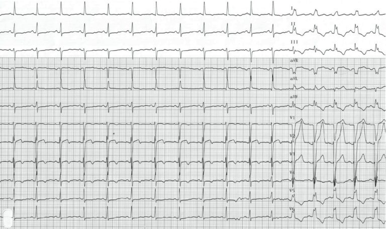 trace-3-3-ecg
