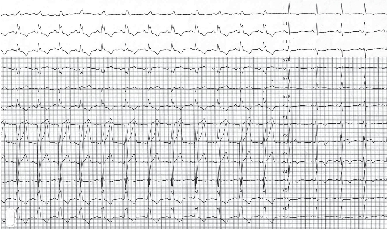 trace-3-3-ecg2