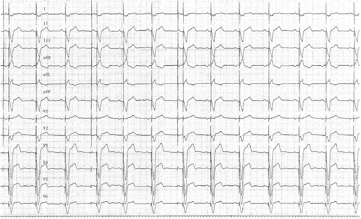 trace-3-8-ecg3