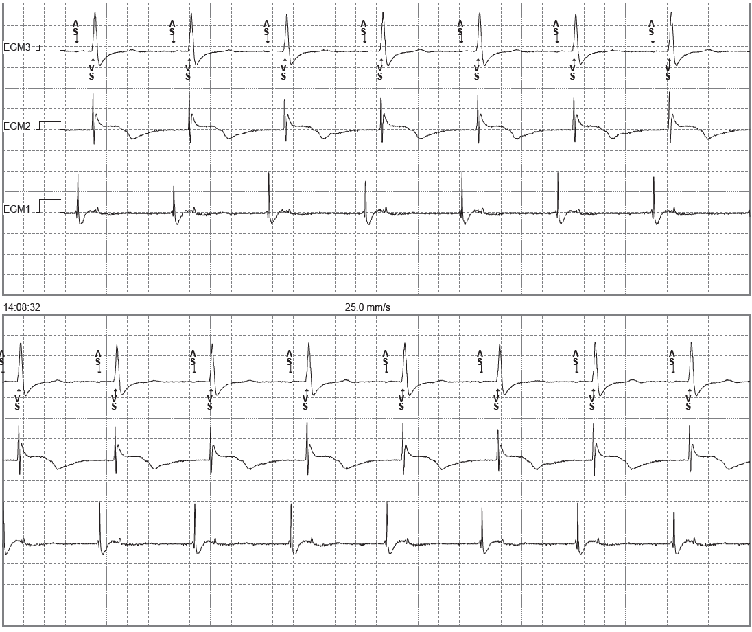trace-4-1-ecg2
