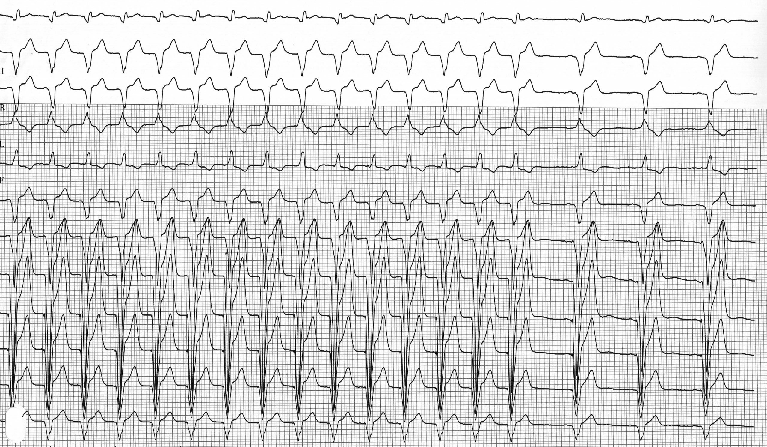 trace-4-10-ecg4