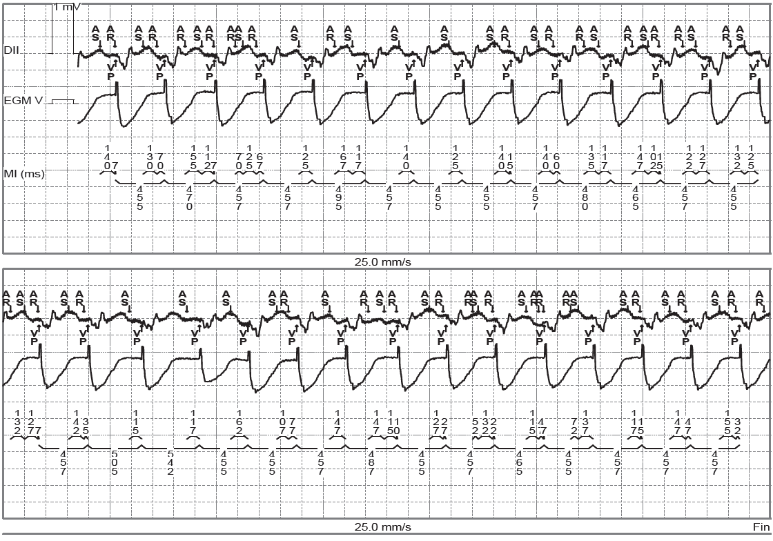 trace-4-11-ecg2