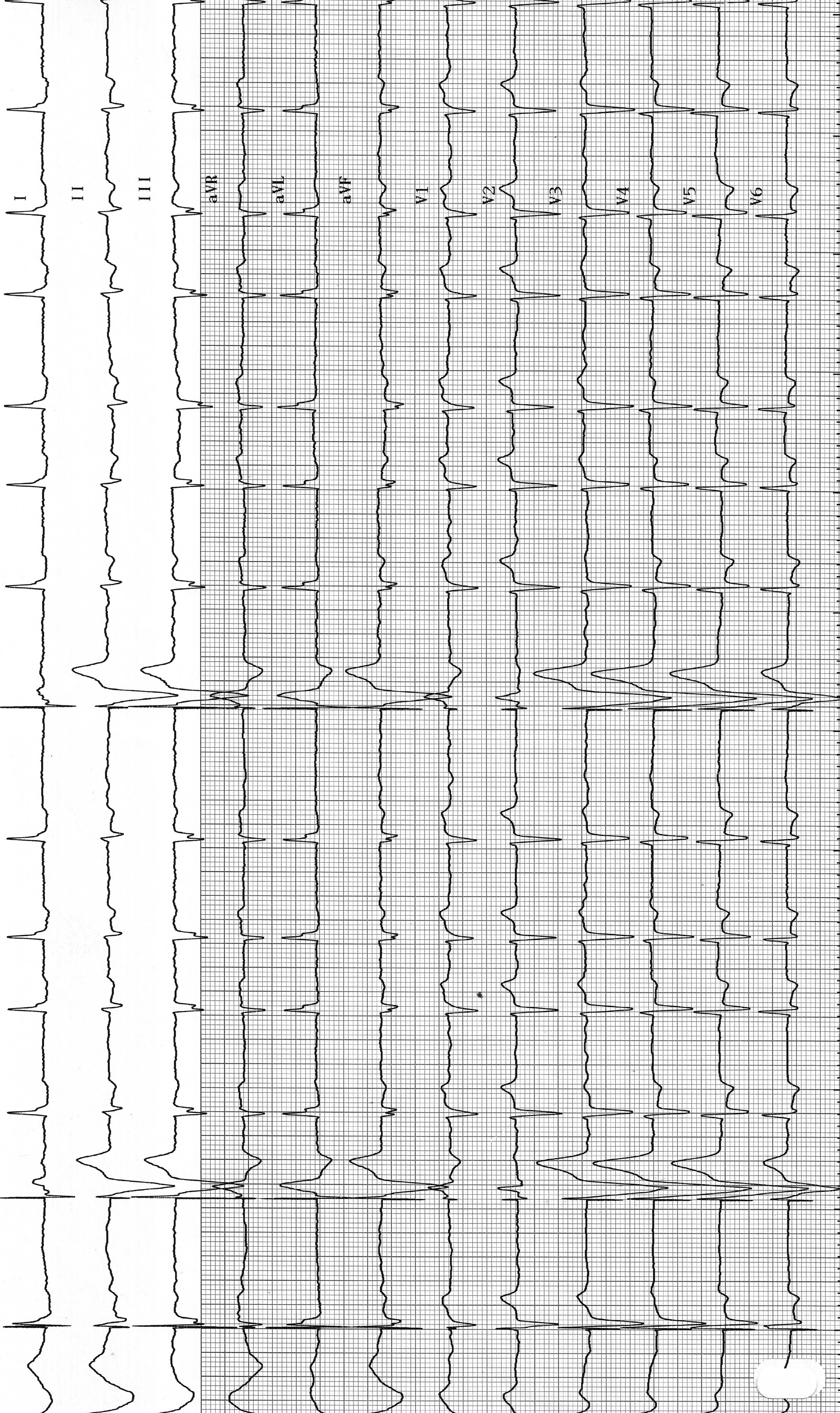 trace-4-12-ecg2