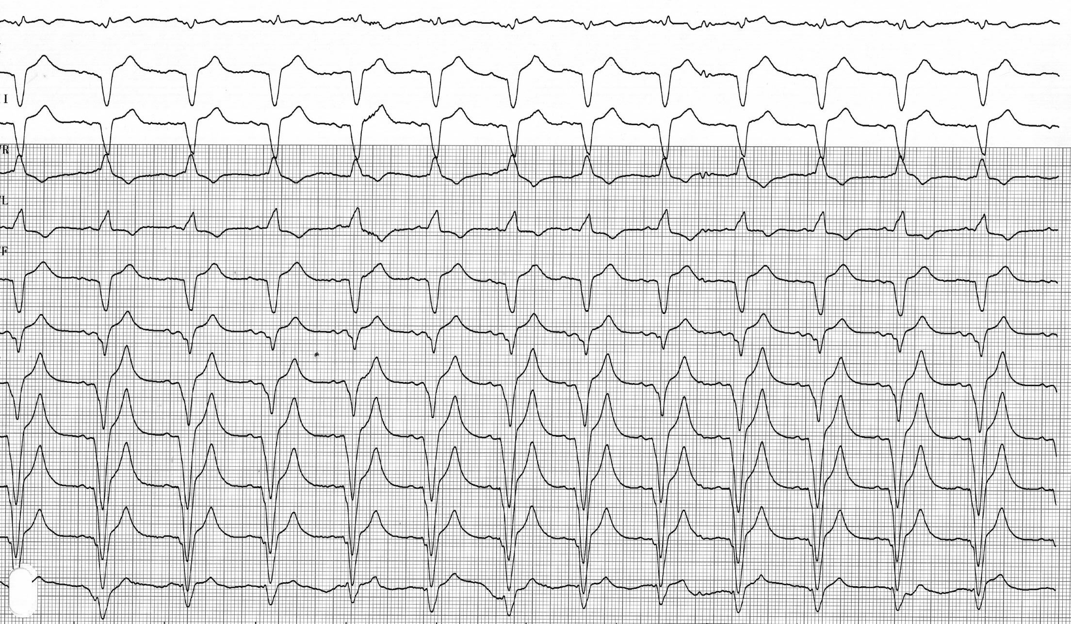 trace-4-13-ecg3
