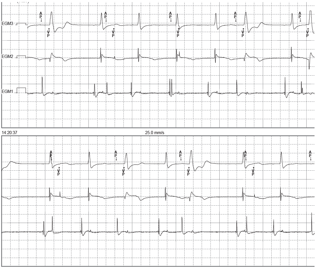 trace-4-2-ecg2