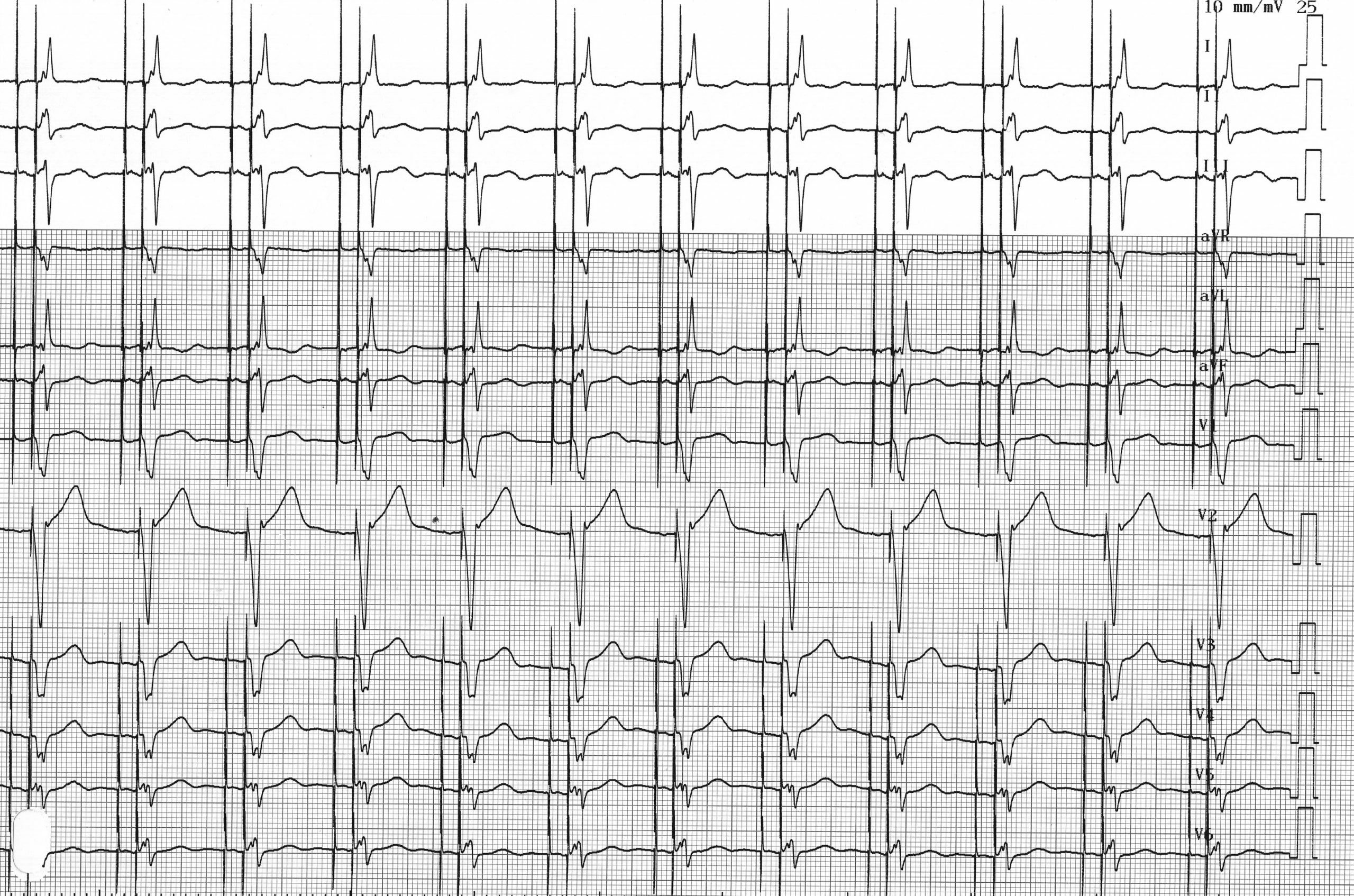 trace-4-6-ecg2