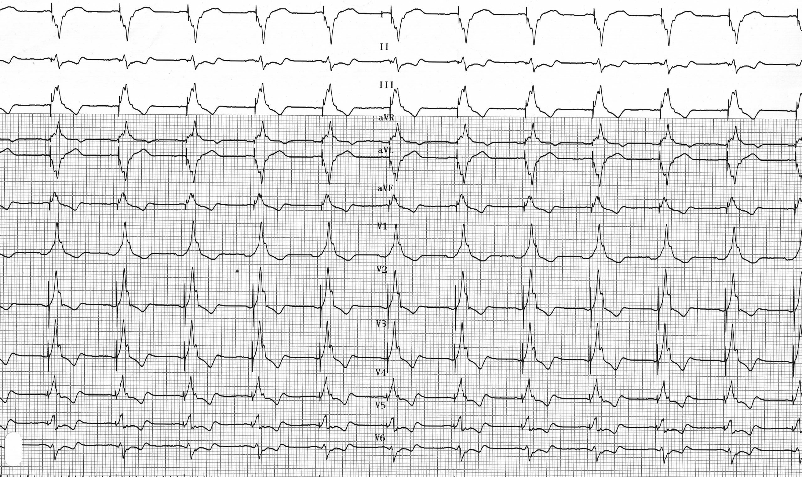 trace-4-7-ecg4