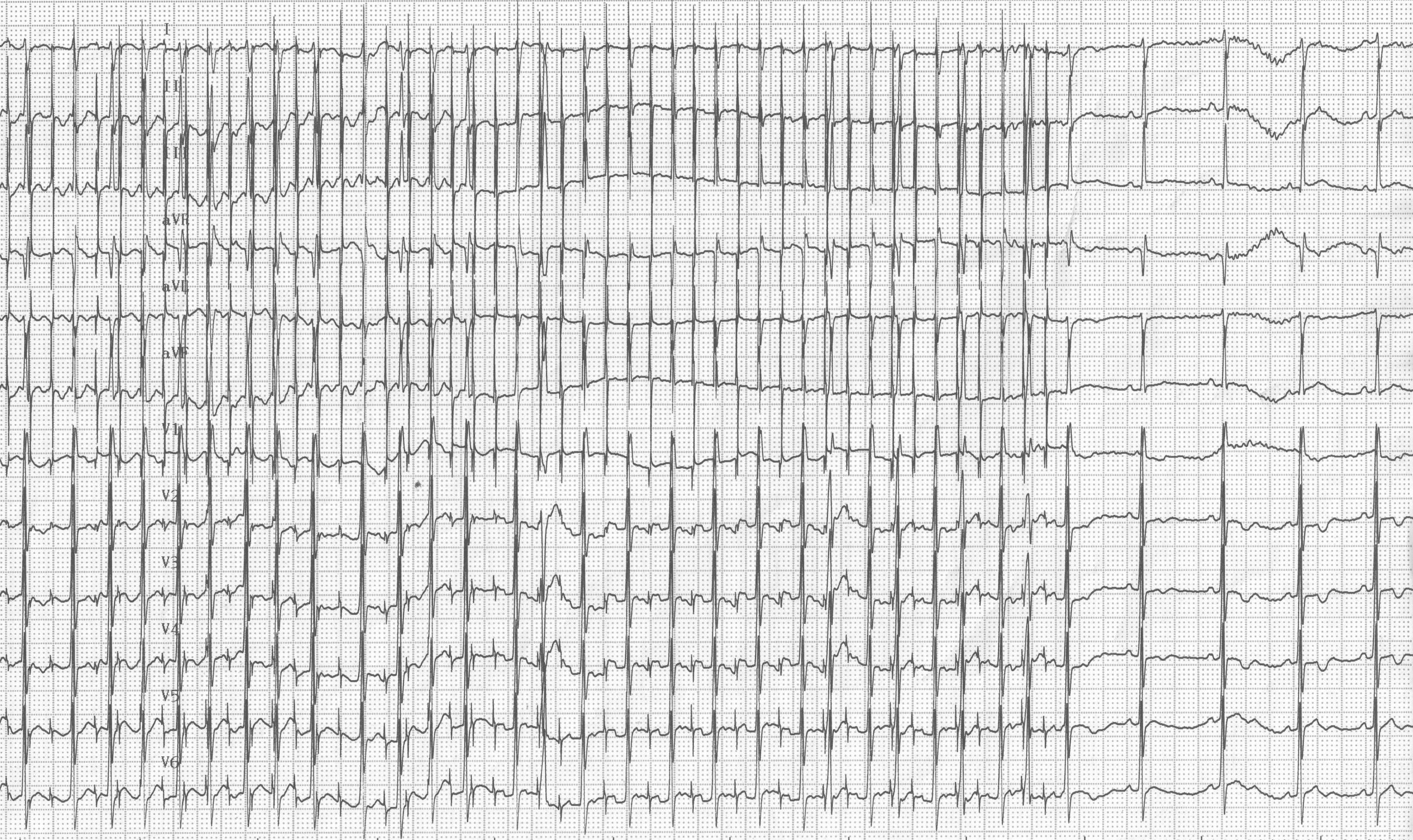 trace-6-11-ecg3