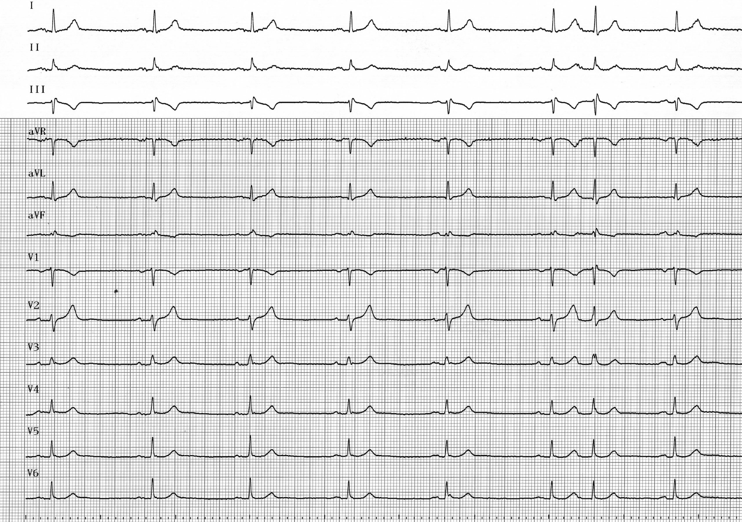 trace-6-3-ecg2