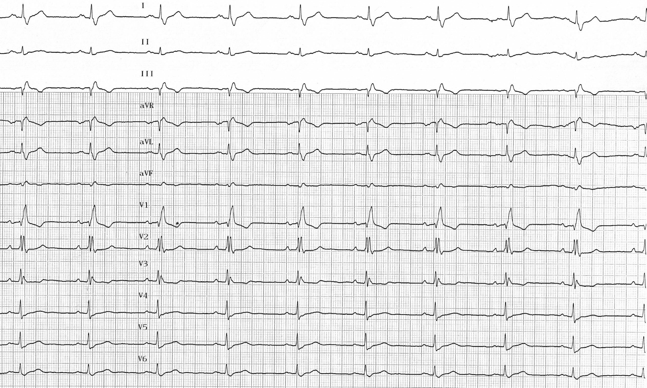 trace-6-4-ecg2