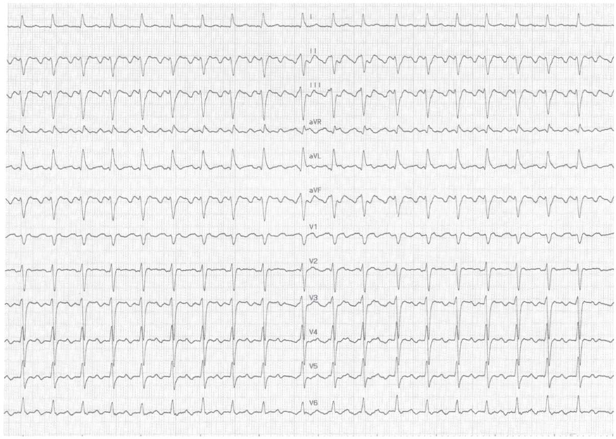 trace-6-8-ecg2