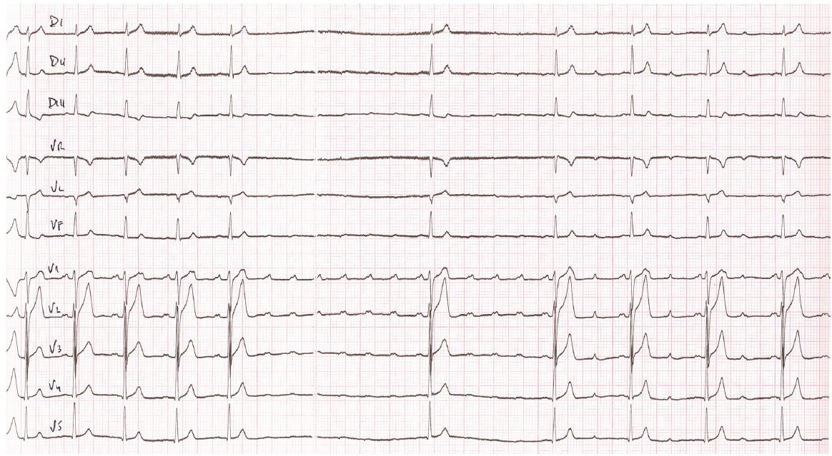 trace-6-9-ecg2