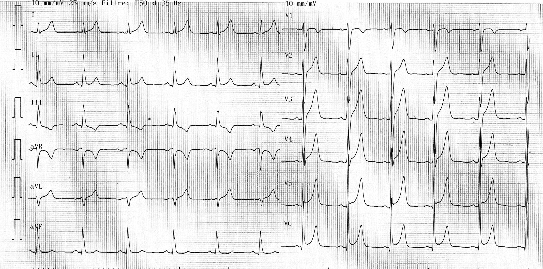 trace-7-1-ecg2