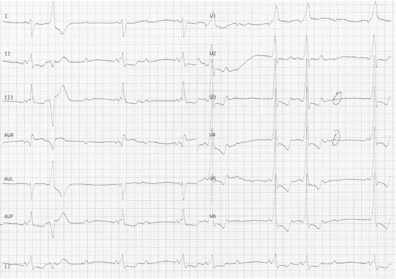 trace-7-10-ecg2