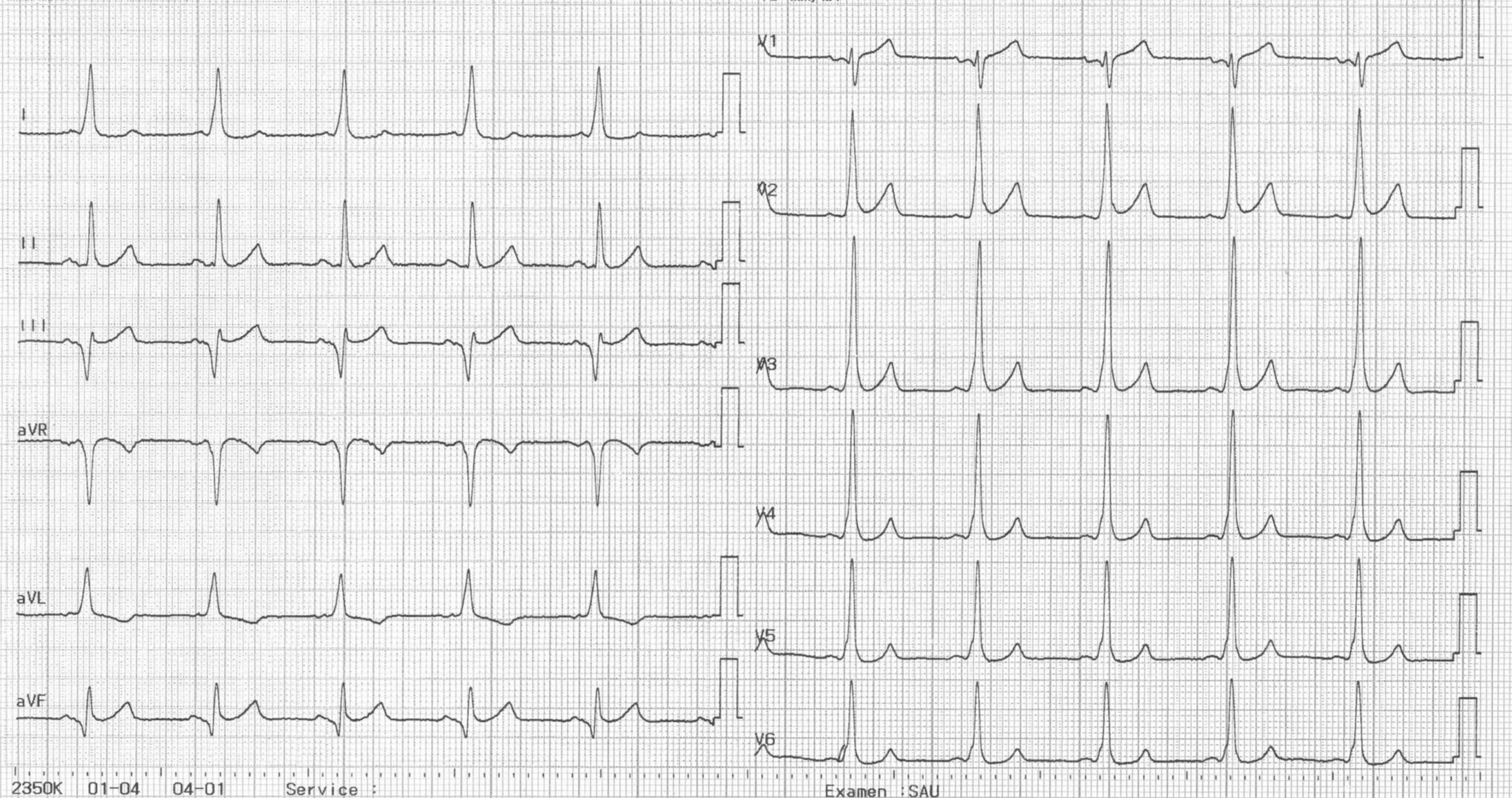trace-7-11-ecg2