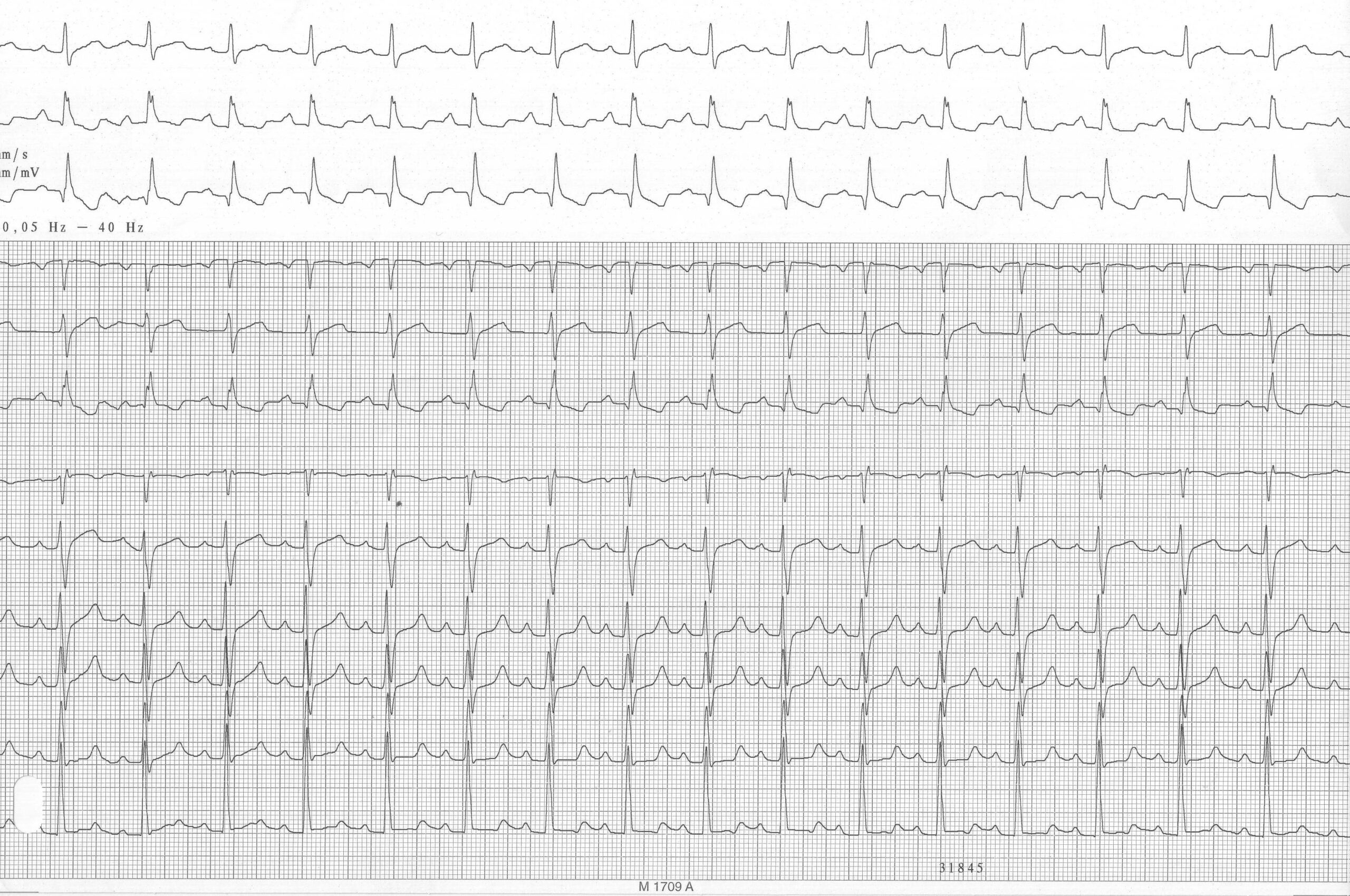 trace-7-14-ecg2