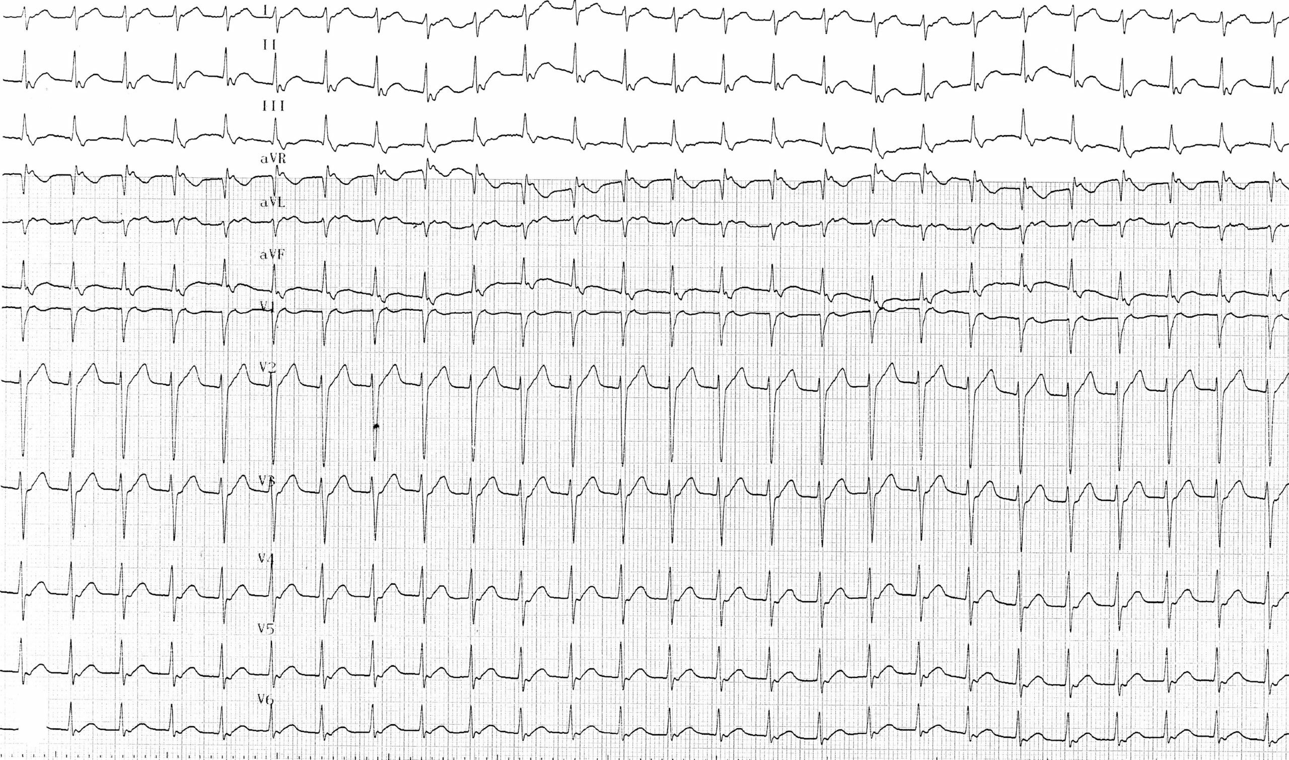 trace-7-15-ecg2