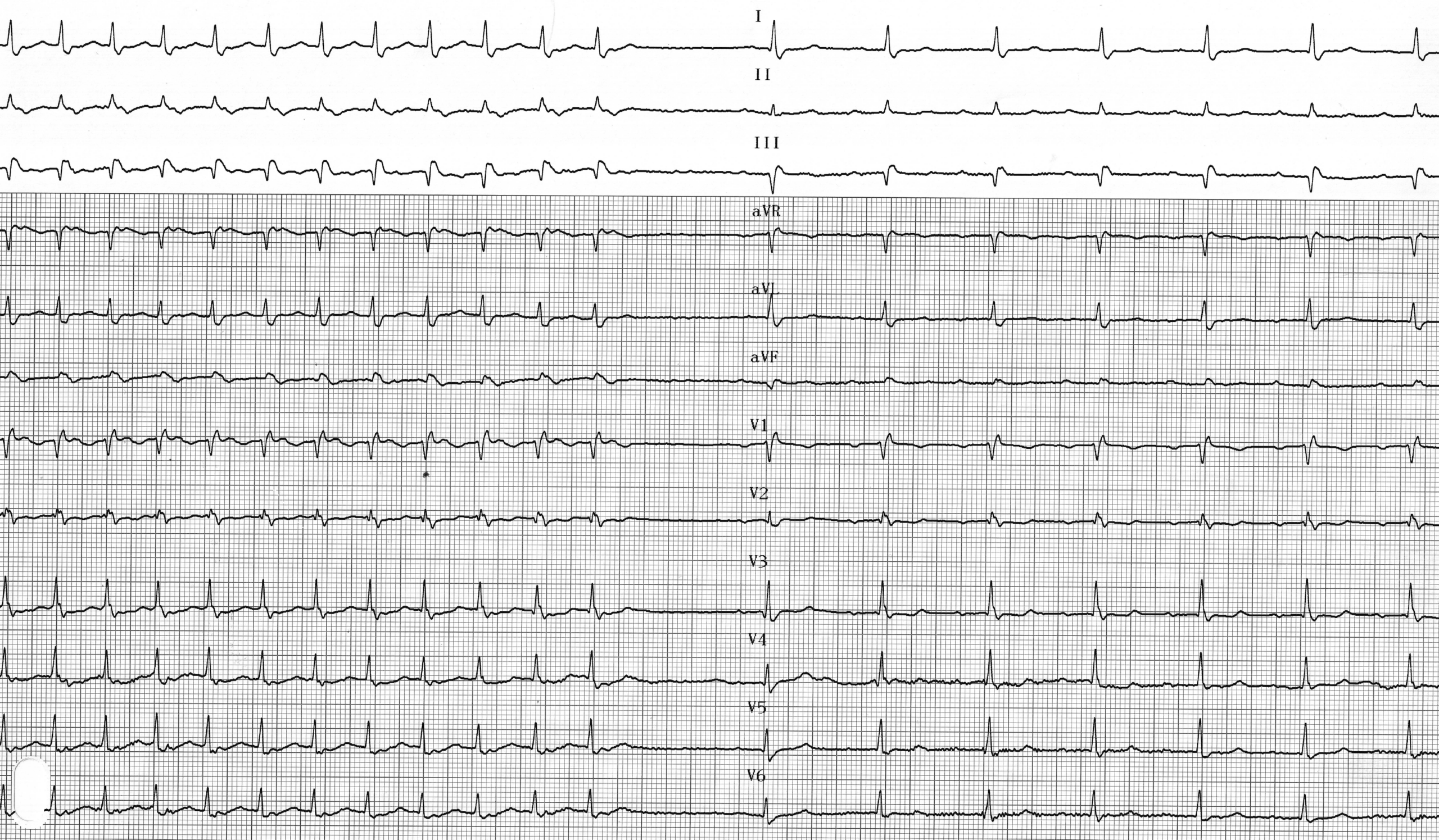 trace-7-16-ecg2