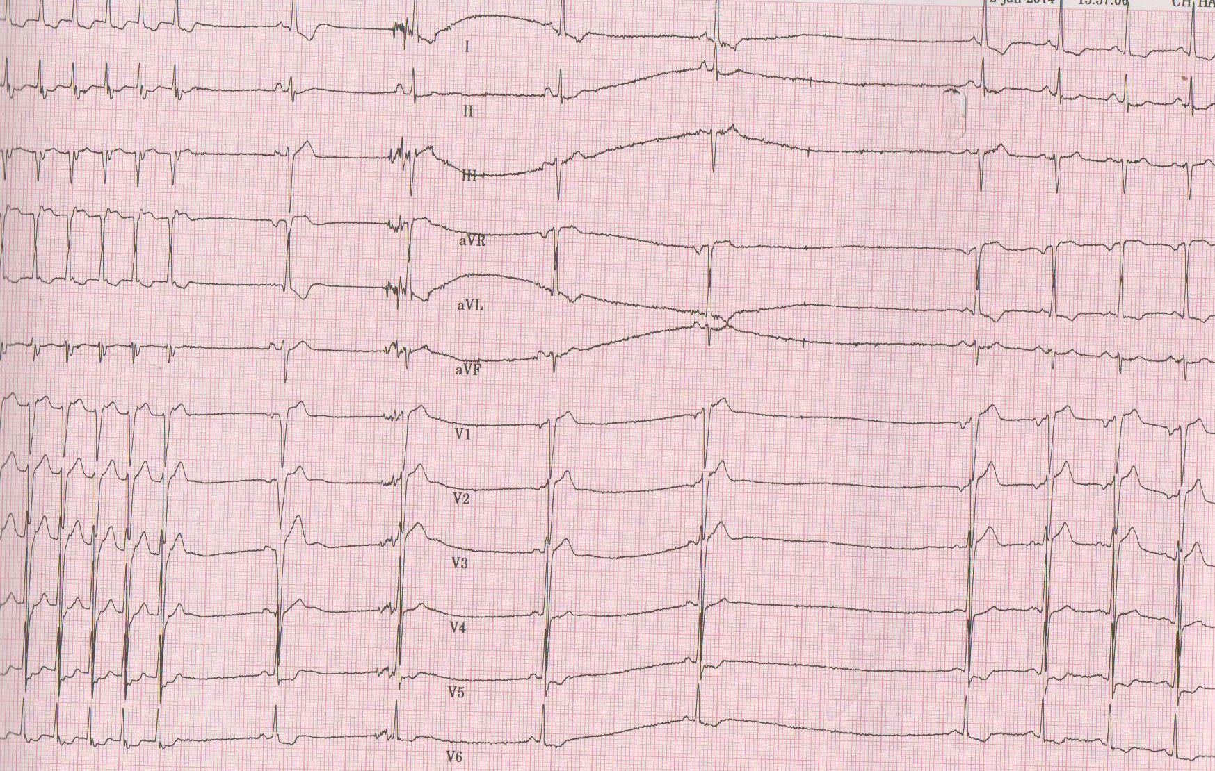 trace-7-17-ecg2