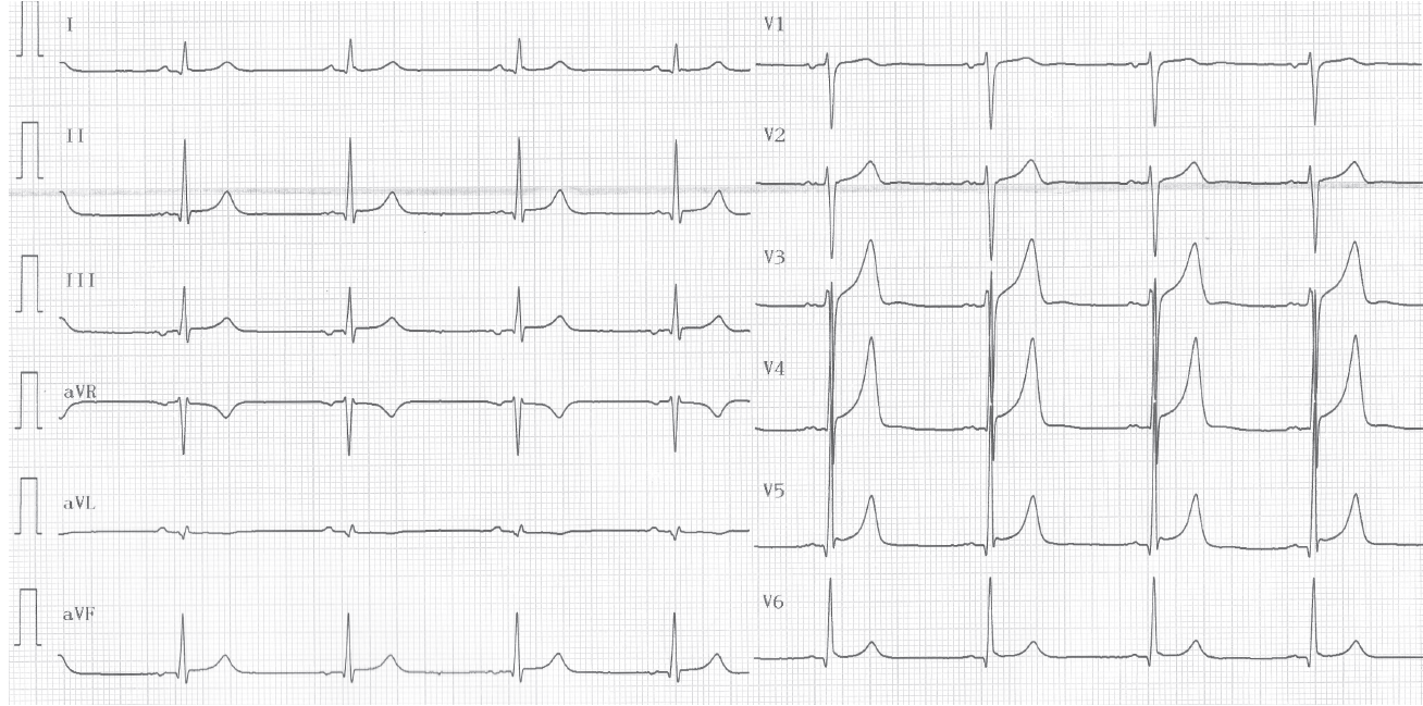trace-7-4-ecg3