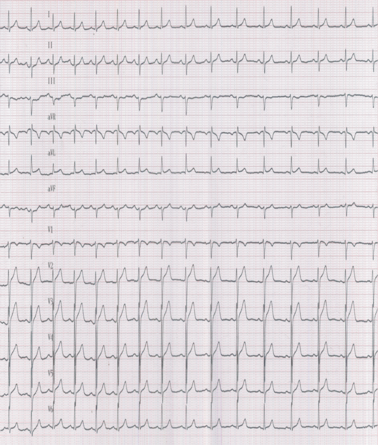 trace-7-5-ecg