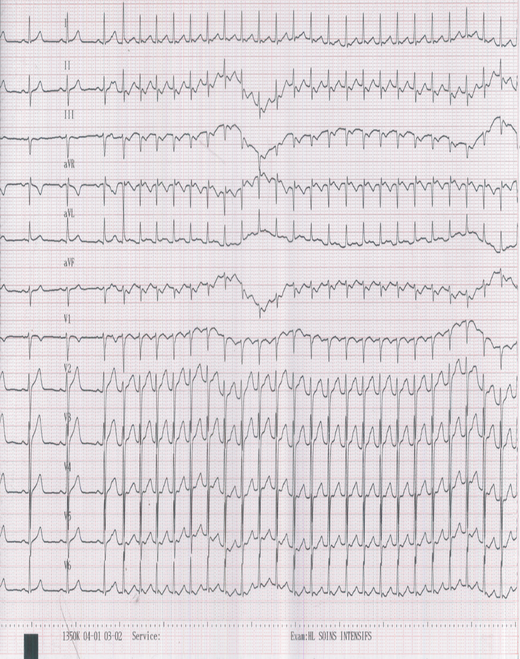 trace-7-5-ecg2
