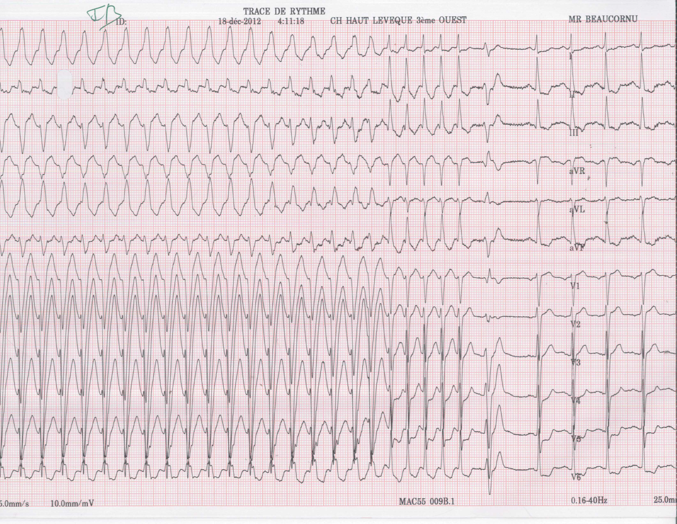 trace-7-6-ecg5