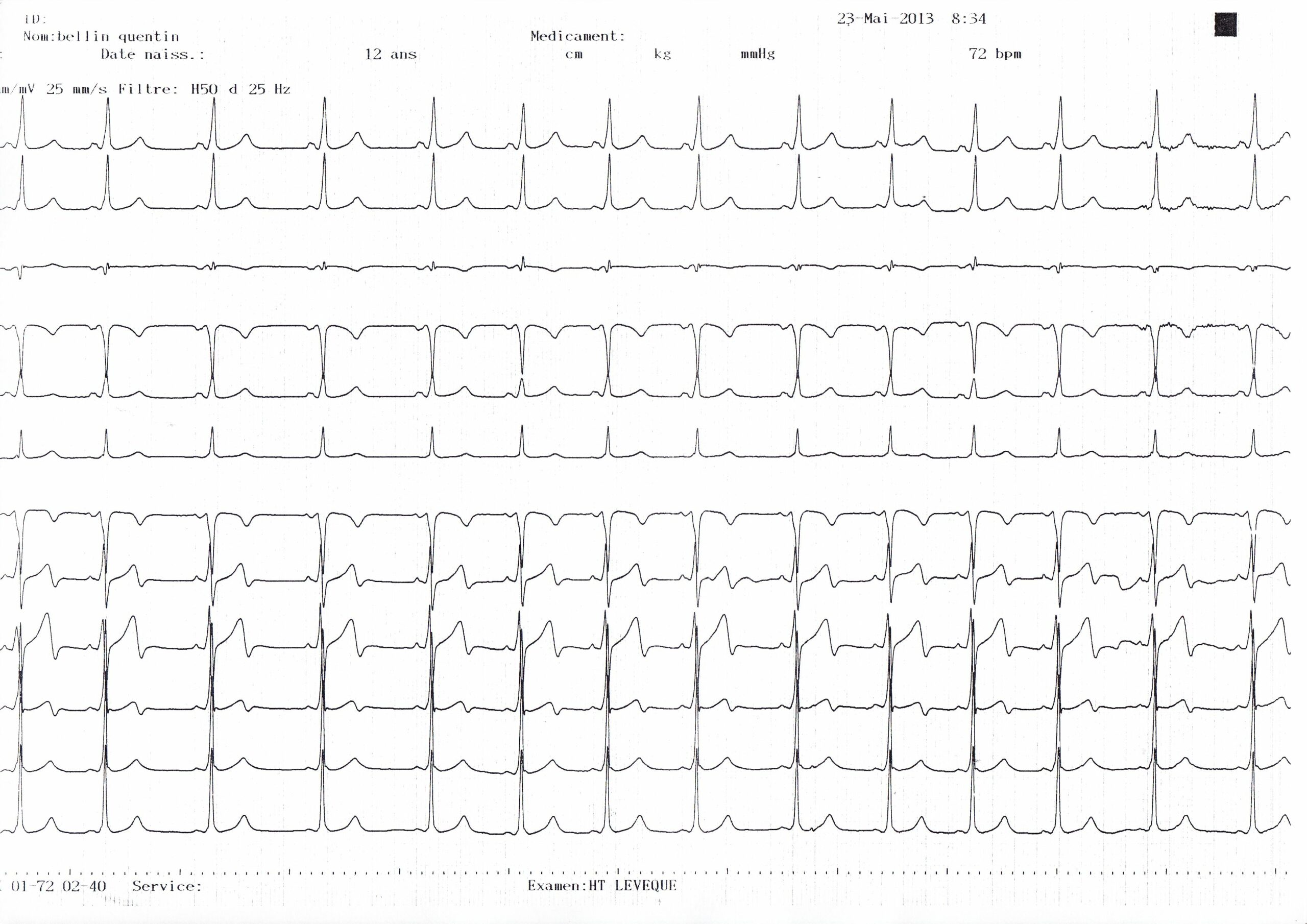 trace-7-8-ecg2