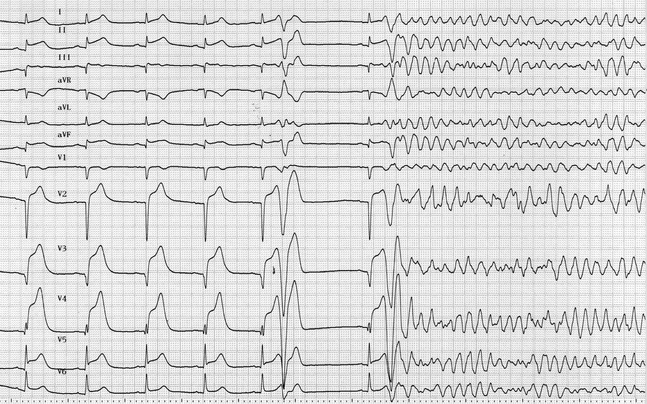 trace-8-10-ecg3