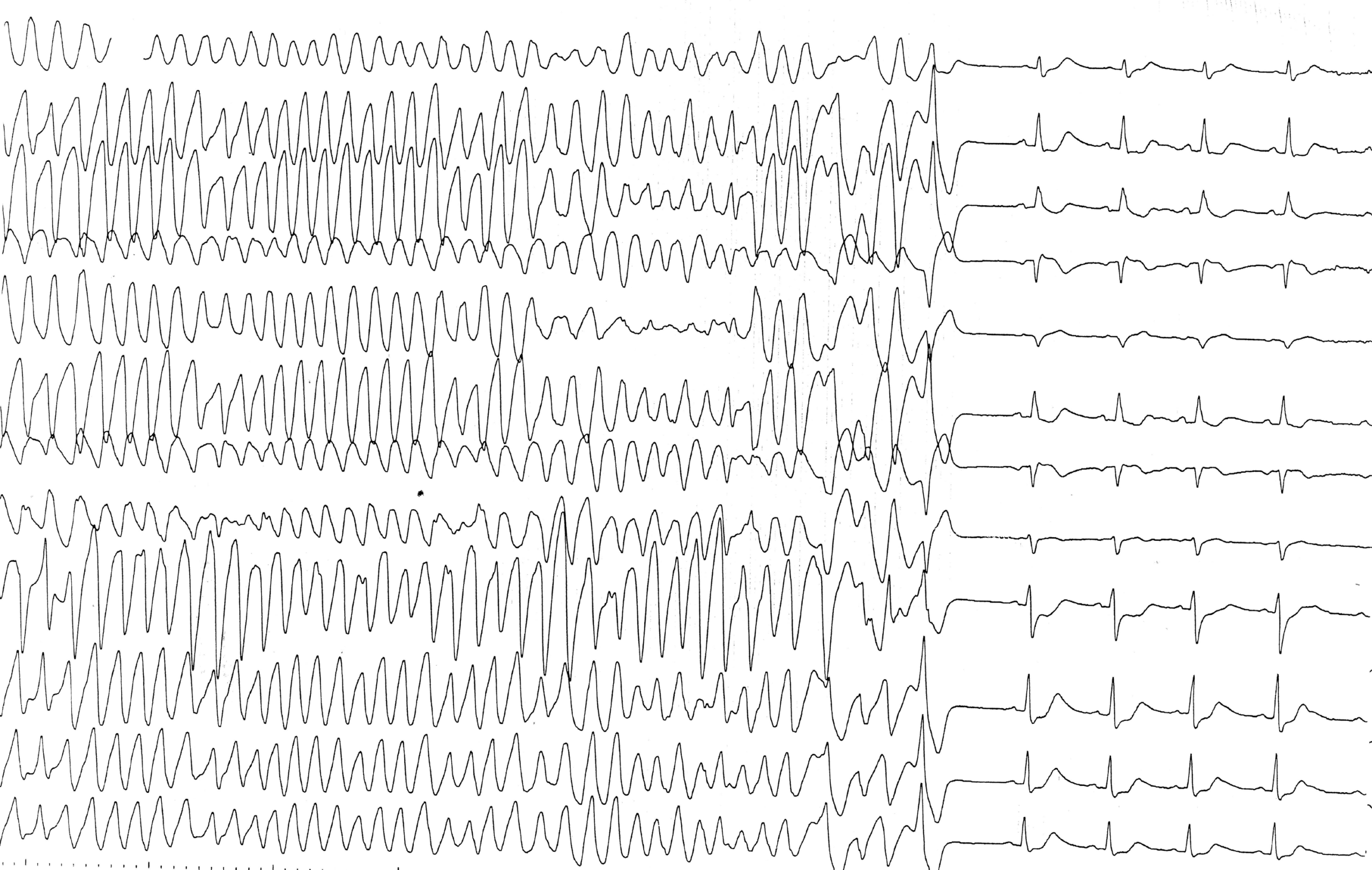 trace-8-11-ecg3