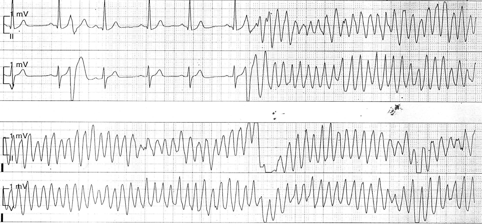 trace-8-12-ecg2