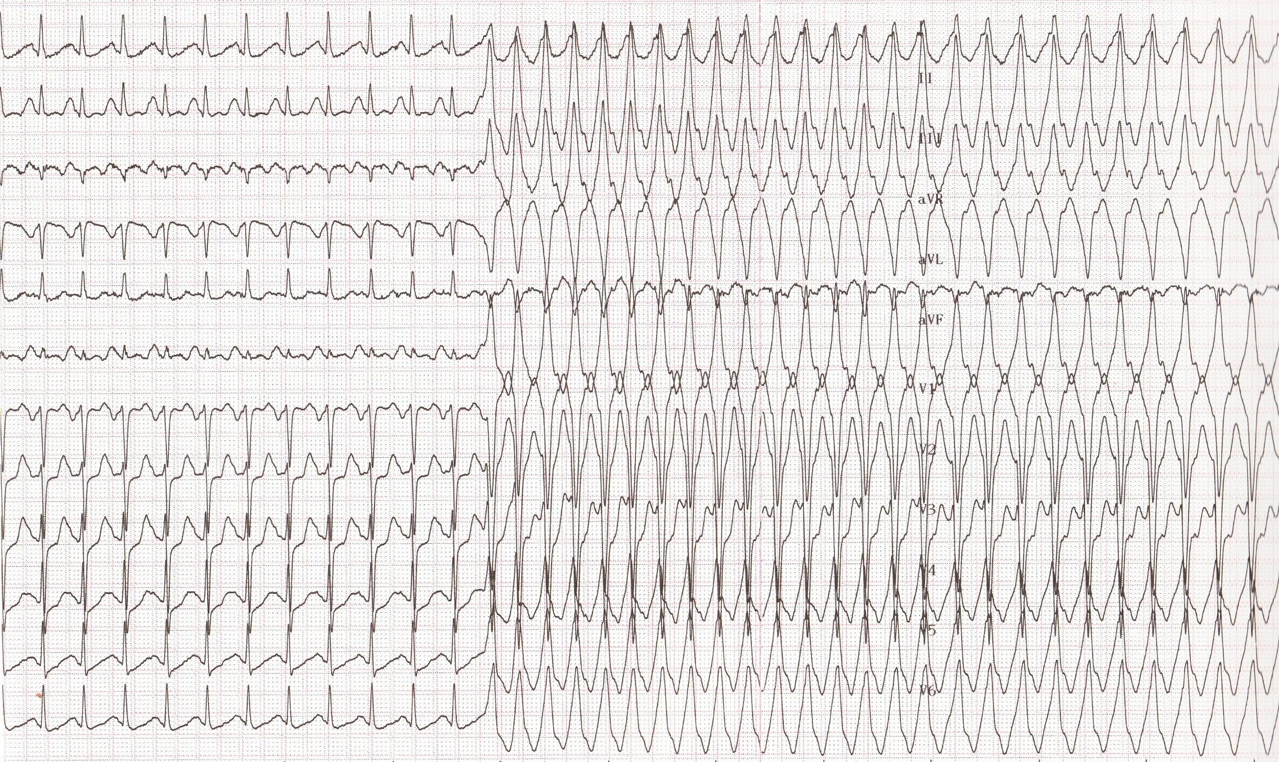 trace-8-2-ecg2