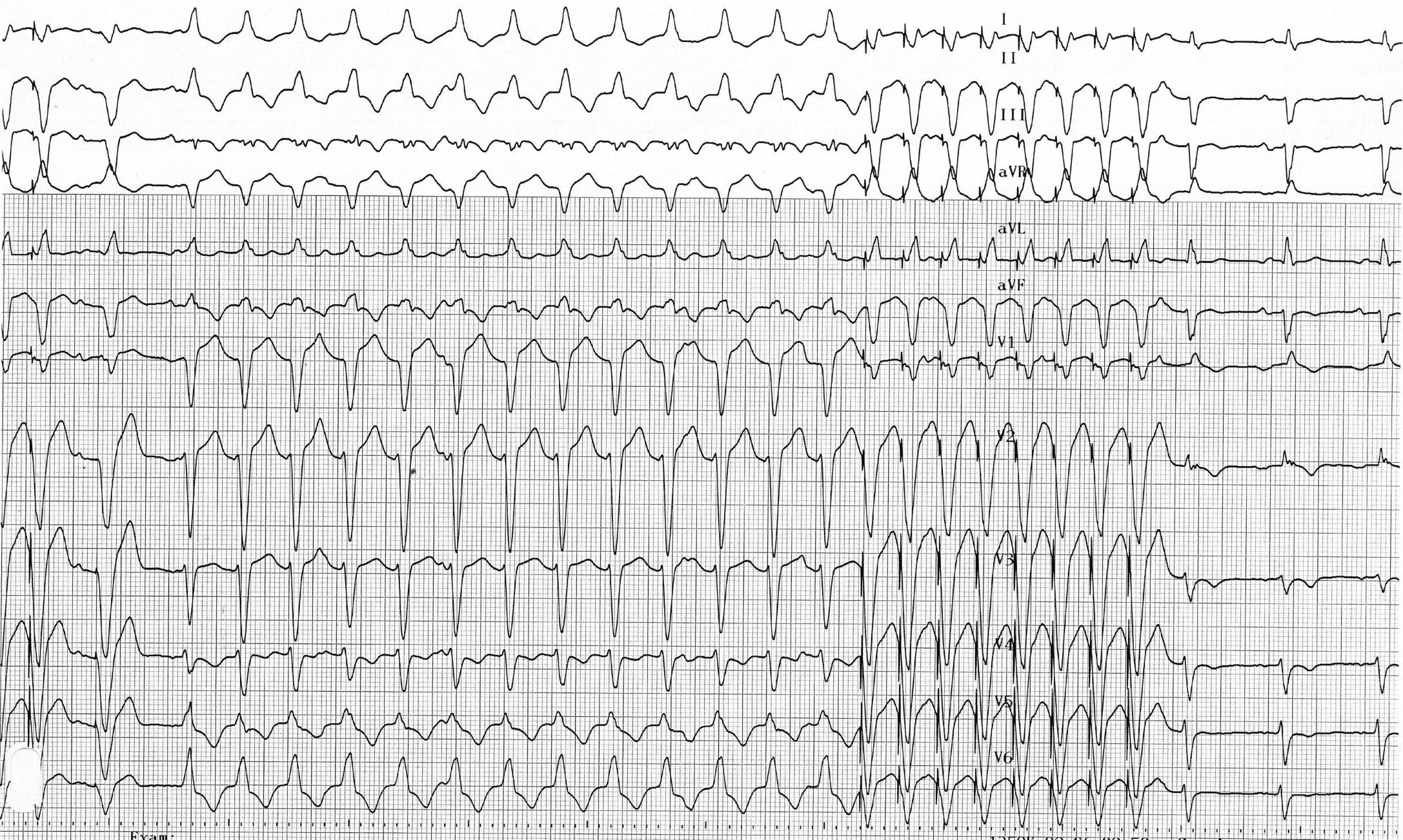 trace-8-3-ecg3