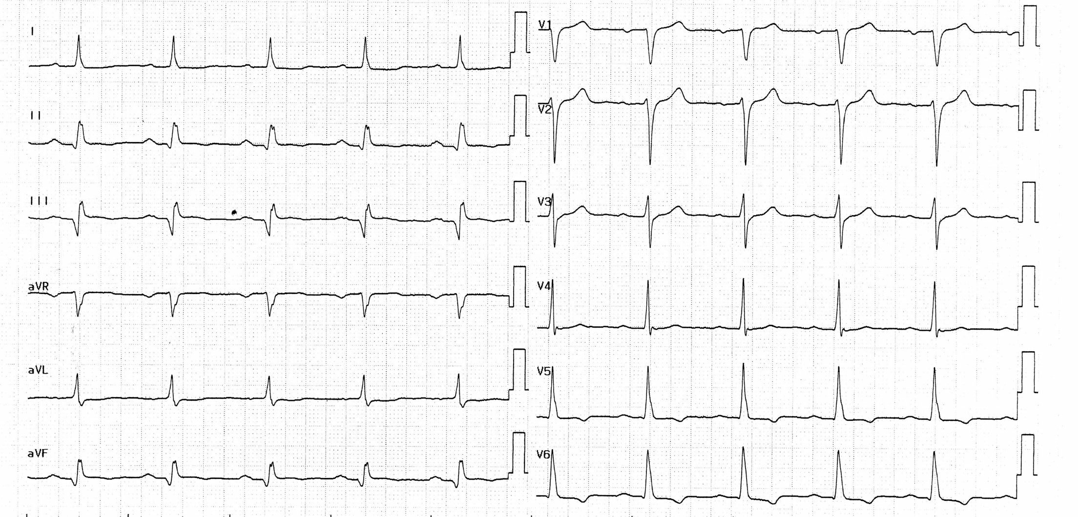 trace-8-4-ecg2